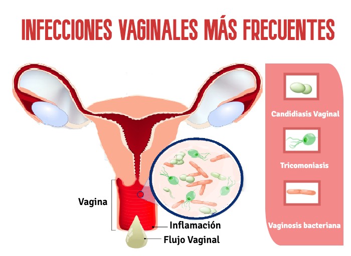 Infecciones vaginales más frecuentes y cómo prevenirlas